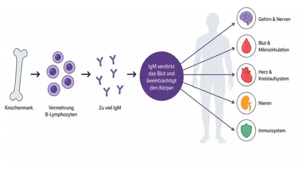 Knochenmark vermehrt B-Lymphozyten, was zu viel IgM führt. Dies verdickt das Blut und beeinträchtigt Gehirn, Herz, Nieren und Immunsystem, was auf MGUS-Beschwerden hindeutet.