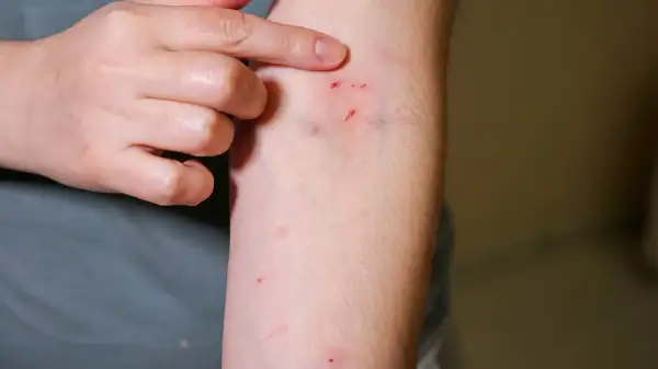Dłoń wskazuje na drobne skaleczenia na ramieniu, które mogą być oznaką różnych rodzajów zakażeń ran.