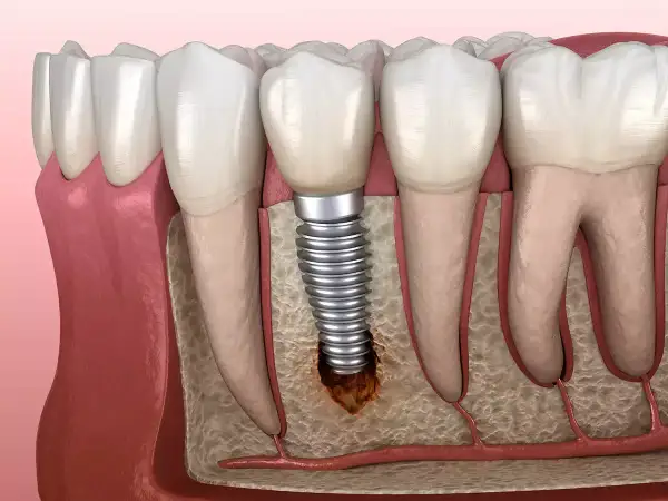 Ilustración de un implante dental con bolsas inflamatorias alrededor, mostrando la pérdida ósea y la irritación de los tejidos.