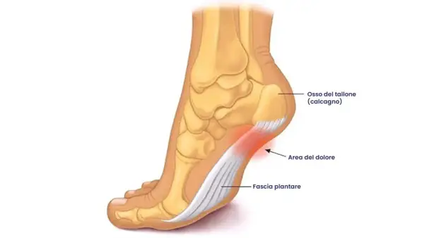 Illustrazione anatomica del piede che mostra l'osso del tallone, la fascia plantare e l'area del dolore, tipica del camminare con la tallonite.