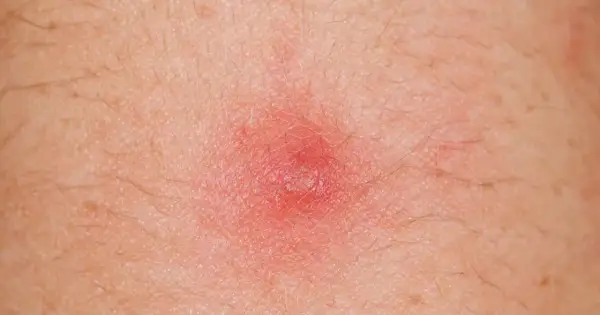 Czerwona, zapalna krostka na skórze, która może wymagać leczenia detreomycyną.