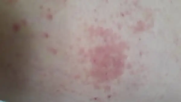 Éruption cutanée rosée sur la peau, possiblement liée à un staphylocoque doré combien de temps après opération.