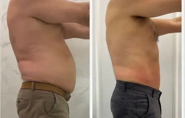 Liposukcja: Modelowanie sylwetki czy odchudzanie? Pełny przewodnik