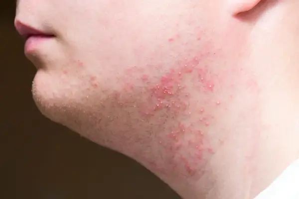 Peau irritée après rasage, avec des rougeurs et de petits boutons sur la joue.