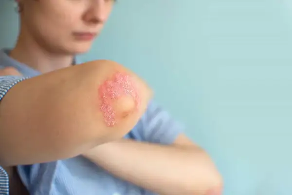 Codo con parches rojos y escamosos, indicativos de psoriasis en niños.