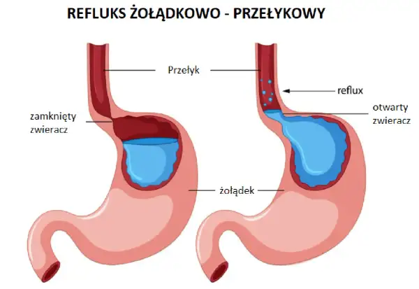 Ilustracja pokazuje, co to refluks żołądkowo-przełykowy: cofanie się treści żołądkowej do przełyku z powodu otwartego zwieracza.