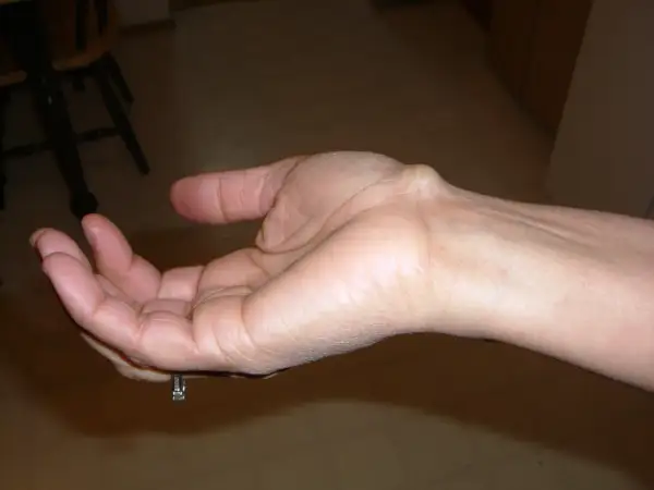 Polso con cisti tendinea visibile, una protuberanza sulla parte superiore.