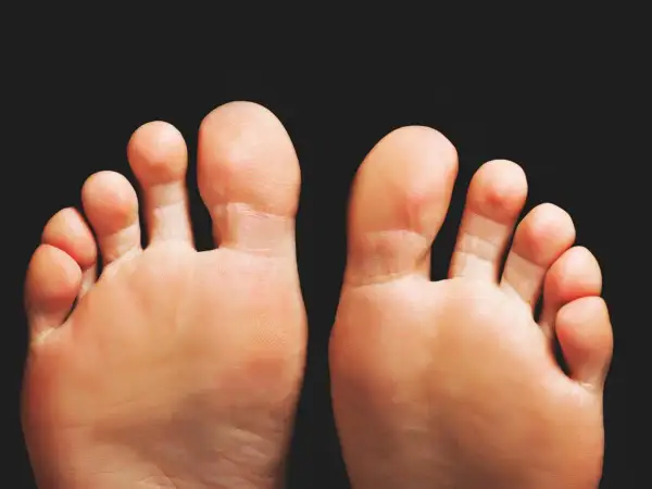 Piedi con alluce valgo, un problema comune per cui esistono diversi rimedi.