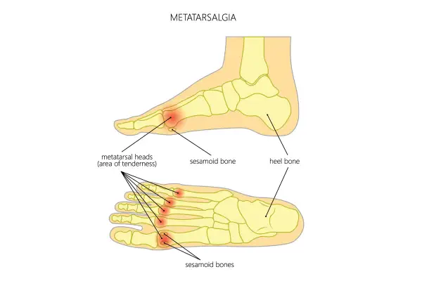 Illustrazione anatomica del piede che mostra la metatarsalgia. Evidenziate le aree di dolorabilità nelle teste metatarsali e le ossa sesamoidi, con riferimento al tarso e metatarso.