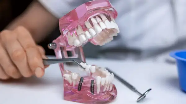 Model szczęki z implantami i mostem tymczasowym. Dowiedz się, jak długo można nosić most tymczasowy.