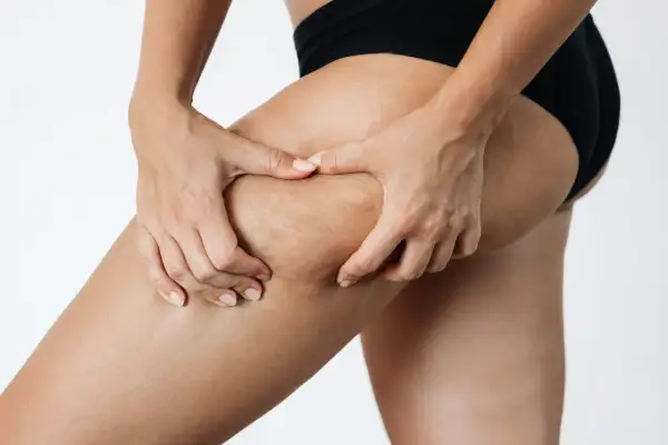 Mani che pizzicano la coscia, mostrando i diversi stadi della cellulite sulla pelle.