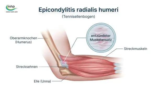 Illustration zeigt den Tennisellenbogen (Epicondylitis radialis humeri) mit entzündetem Muskelansatz. Darf man mit Tennisarm arbeiten? Ja, oft mit Anpassungen.