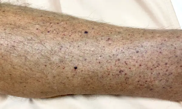Hud med många små lila prickar, som kan vara symtom på leukemi hos barn.