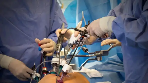 Chirurgen führen eine minimalinvasive Prostata-OP durch. Hände in Handschuhen bedienen feine Instrumente, die durch kleine Schnitte eingeführt werden.