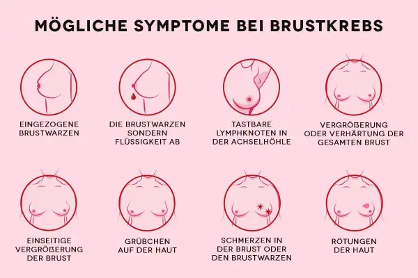 Grafik zeigt mögliche Symptome von Brustkrebs, darunter tastbare Lymphknoten in der Achselhöhle und eine Vergrößerung oder Verhärtung der Brust.