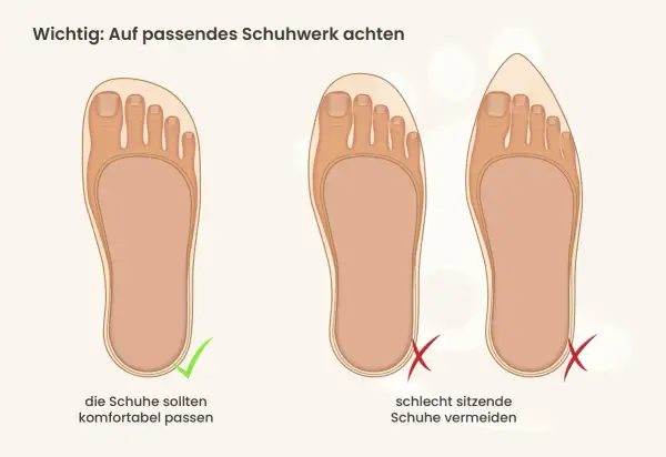 Passende Schuhe sind wichtig, um Druckstellen am Zeh zu vermeiden. Links ein Fuß im gut sitzenden Schuh, rechts Füße in zu engen Schuhen.