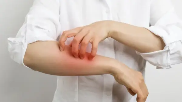 Une personne se gratte le bras, la peau rougie et irritée, possiblement à cause d'une allergie au calcaire.