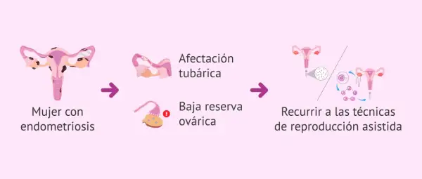 Ilustración muestra cómo la endometriosis puede afectar las trompas y ovarios, llevando a la necesidad de técnicas de reproducción asistida para el embarazo.