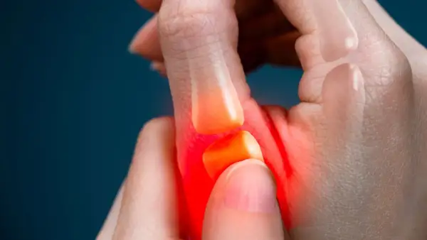 Main d'une personne souffrant de tendinite au pouce, avec une zone rouge indiquant la douleur. Le traitement de la tendinite du pouce est essentiel.
