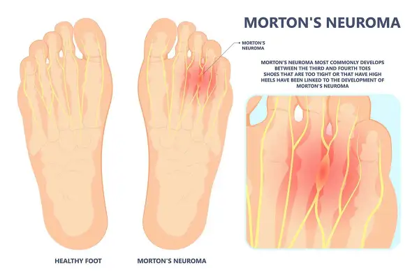 Illustration zeigt gesunde Fußsohle und Morton-Neurom. Selbsthilfe bei Morton-Neurom durch passende Schuhe ist wichtig.