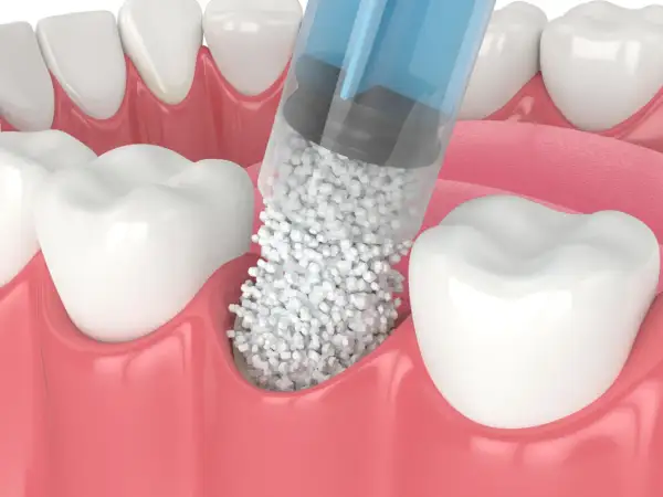 Jeringa aplicando material para poner hueso en la encía, cerca de los dientes.