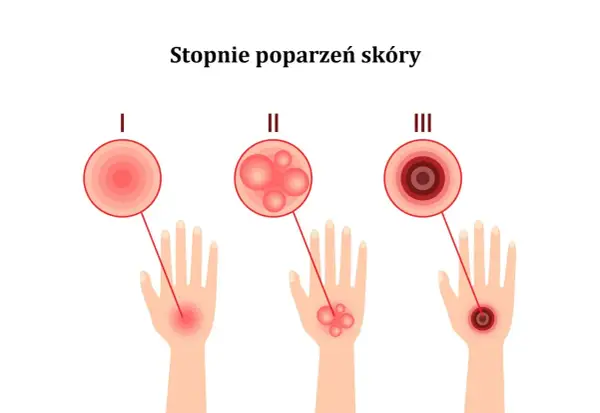 Ilustracja pokazuje stopnie poparzeń skóry: I stopień to zaczerwienienie, II stopień to bąble po oparzeniu słonecznym, a III stopień to głębokie uszkodzenie.