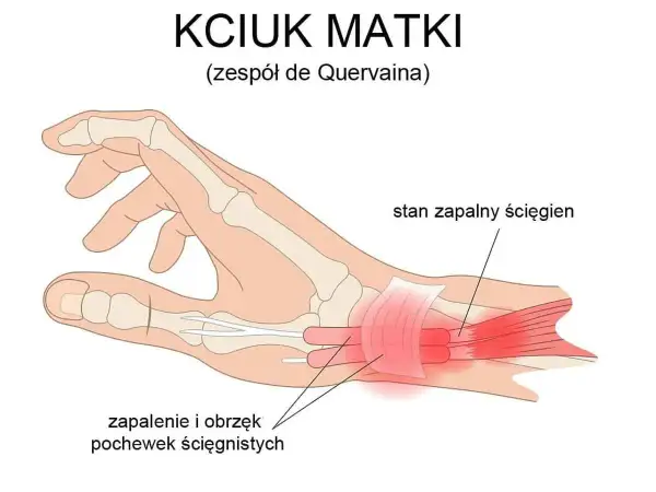 Ilustracja anatomiczna dłoni z zaznaczonym zapaleniem pochewek ścięgnistych kciuka.