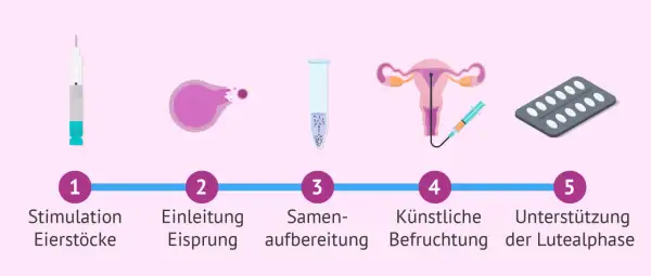 Der Insemination Ablauf: Stimulation der Eierstöcke, Eisprung-Einleitung, Samenvorbereitung, künstliche Befruchtung, Lutealphase-Unterstützung.