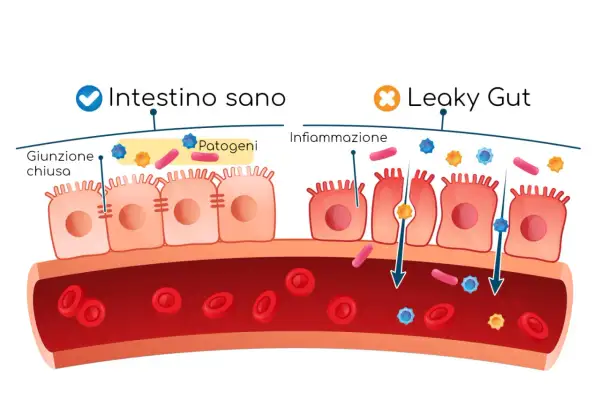 Intestino sano con giunzione chiusa e patogeni bloccati. Leaky gut con infiammazione, dove i patogeni attraversano la barriera intestinale.