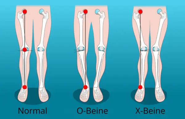 Vergleich von normalen Beinen, O-Beinen und X-Beinen. Die Darstellung zeigt die Knochenstruktur und die Ausrichtung der Gliedmaßen.