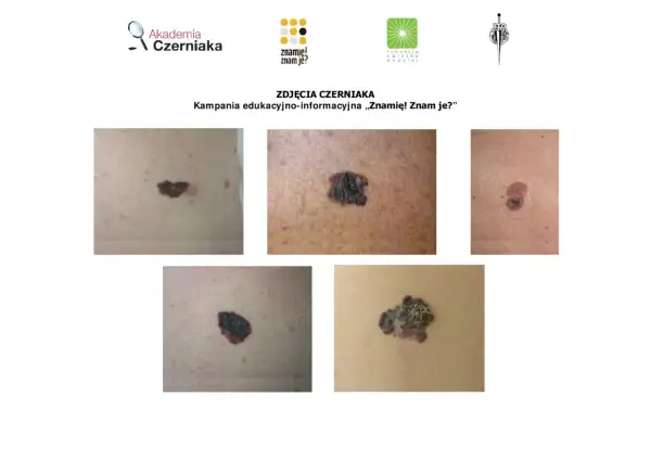 Różne rodzaje znamion i czerniaków. Kampania edukacyjna "Znamię! Znam je?".