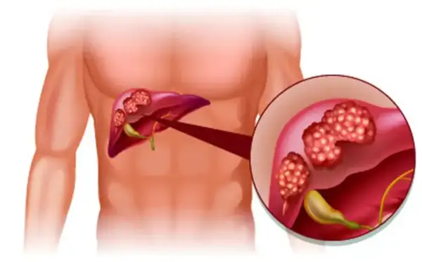 Illustration av lever med tumörer. Förstorad bild visar detaljer av tumörerna, som kan vara tecken på inflammation i levern symtom.