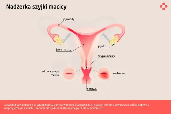 Ilustracja przedstawia budowę narządów rodnych kobiety, z zaznaczoną nadżerką szyjki macicy, która jest wrzodziejącym ubytkiem.