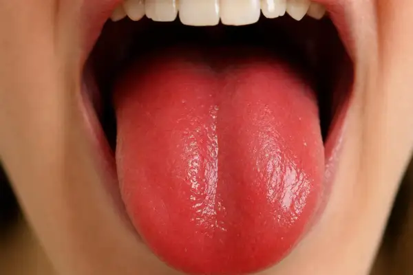 Lingua rossa e liscia, possibile sintomo di carenza vitamina b12.