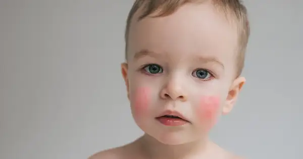 Uroczy chłopiec z rumianymi policzkami, być może z powodu nietolerancji białka mleka krowiego.