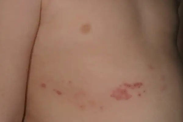 Barnets hud visar ett utslag med röda prickar och blåsor, troligen bältros.