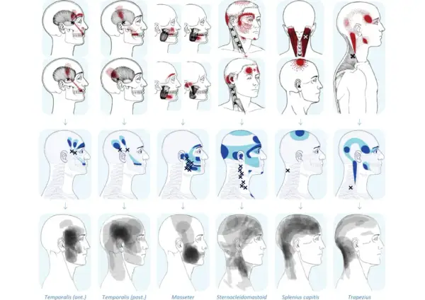 Mappa dolore riferito: illustrazioni di teste umane con aree di dolore evidenziate in rosso e blu, che mostrano la distribuzione del dolore riferito da specifici muscoli.