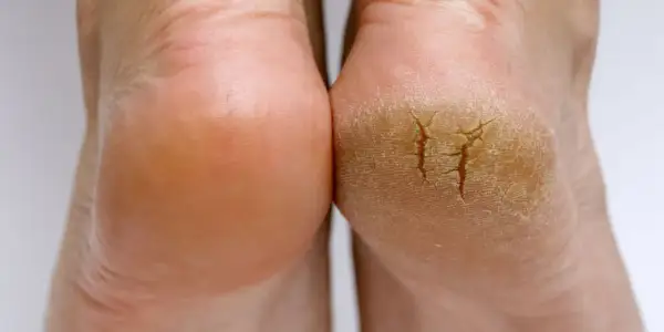 Tiefer Riss in der Ferse? Hausmittel können helfen, die Haut zu regenerieren und Schmerzen zu lindern.