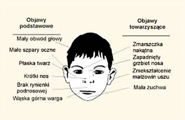 Ilustracja przedstawia twarz dziecka z zaznaczonymi objawami: mały obwód głowy, płaska twarz, krótki nos, wąska górna warga, zmarszczka nakątna, zapadnięty grzbiet nosa, zniekształcenie małżowin uszu.