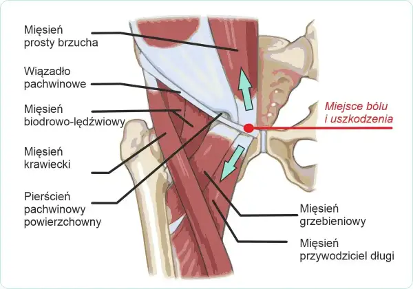 Anatomia pachwiny z zaznaczonym miejscem bólu i uszkodzenia. Ilustracja pokazuje mięśnie brzucha, biodrowo-lędźwiowy, krawiecki oraz pierścień pachwinowy.