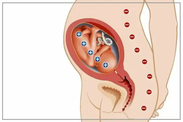 Płód z antygenami Rh+ w macicy matki Rh-. Ilustracja pokazuje potencjalny konflikt serologiczny.
