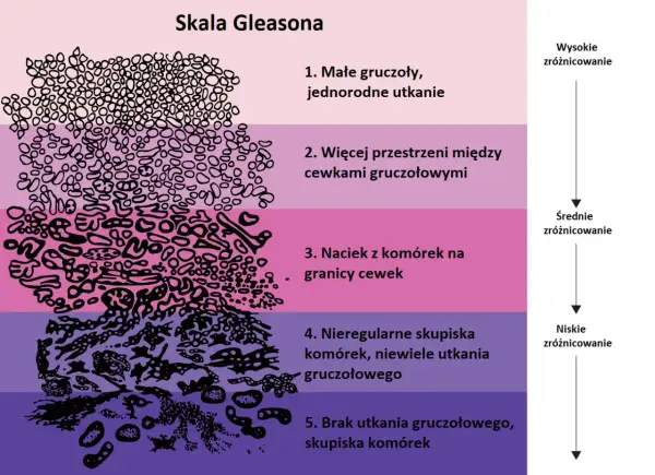 Skala Gleasona ilustruje wyniki biopsji prostaty, pokazując stopnie zróżnicowania komórek od 1 do 5.