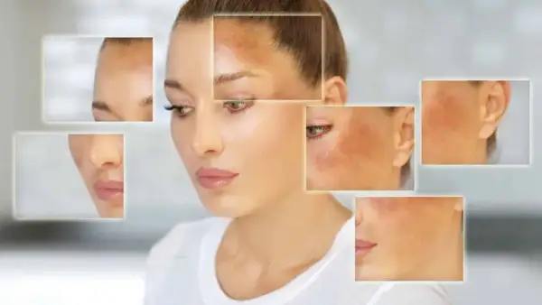 Primer plano de una mujer con manchas oscuras en la cara, mostrando qué es el melasma y sus diferentes áreas afectadas.