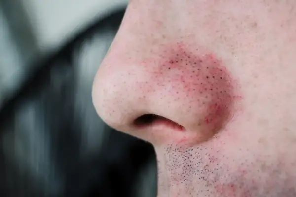 Gros plan sur un nez humain avec des pores dilatés et des points noirs visibles, la peau est légèrement irritée et rouge.
