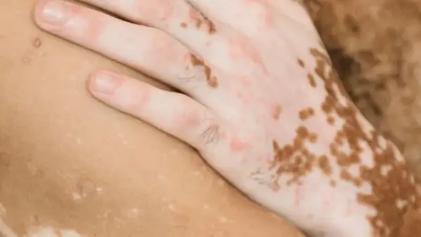 Nära bild på en hand med fläckar av lentigo solaris och vitiligo. Huden har varierande pigmentering.