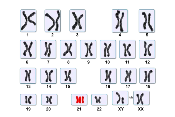 Zestawienie różnych par chromosomów, w tym jedna nieprawidłowa triada.