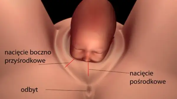 Jak długo boli nacięcie krocza po porodzie? Czas gojenia i ból.