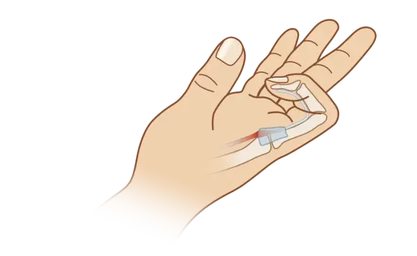 Illustration einer Hand, die zeigt, wie die Finger schmerzen beim Beugen durch eine Entzündung im Sehnenbereich.