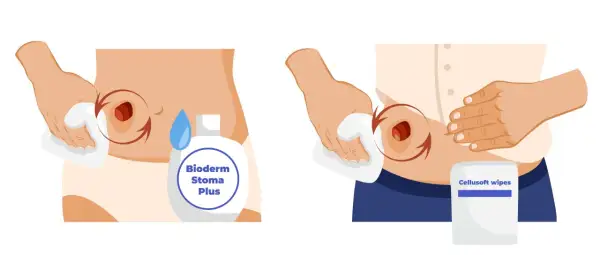 Illustration montrant le nettoyage d'une stomie avec une lingette et un produit, avant de poser une nouvelle poche de stomie pleine.