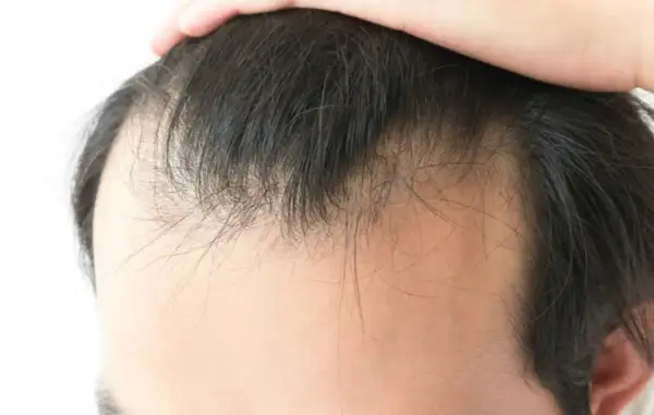 Primer plano de la línea del cabello de un hombre, mostrando adelgazamiento y entradas. Una mano toca la parte superior de la cabeza, quizás preguntándose porque los hombres se quedan calvos.